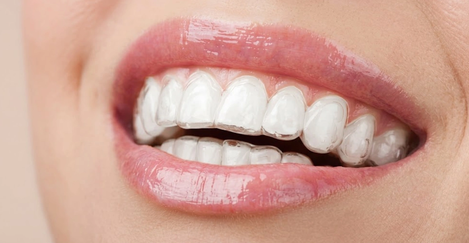 Invisalign Technology Inblog